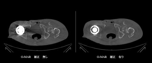 図．人工関節が入った股関節のCT画像（左：従来、右：新しいCT）